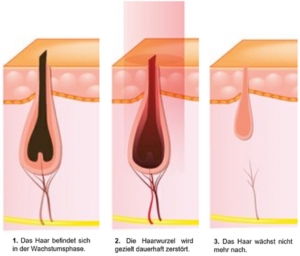 Haarwurzel wird zerstört – dauerhafte Laser Haarentfernung Luzern Ebikon
