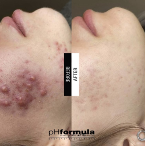 Akne Behandlung Luzern Ebikon Vorher Nachher Ergebnis